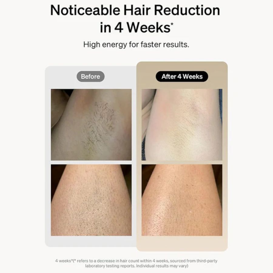Professional Laser Epilator - IPL Body Hair Removal