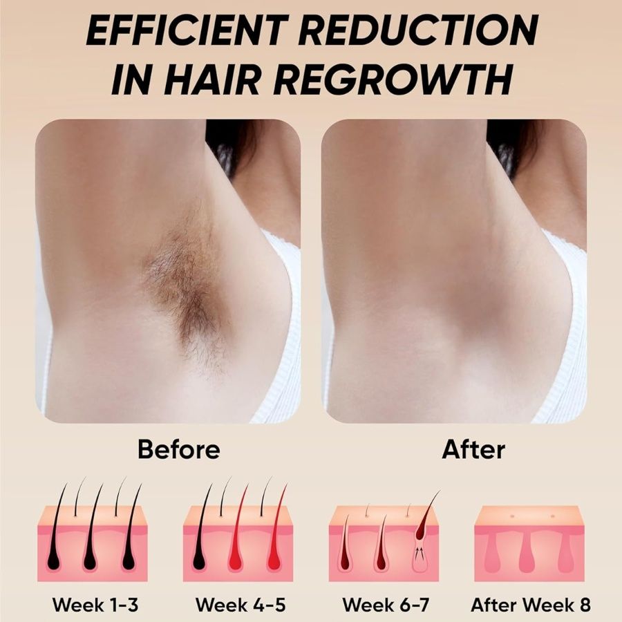 Professional Laser Epilator - IPL Body Hair Removal