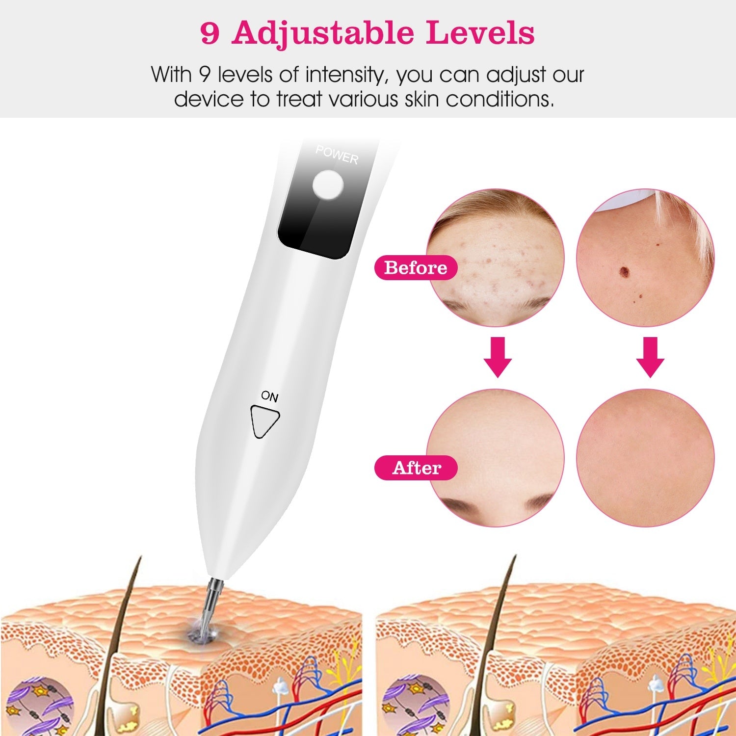 Portable Skin Tag Repair Kit. Portable Home Beauty Equipment Multi-Level